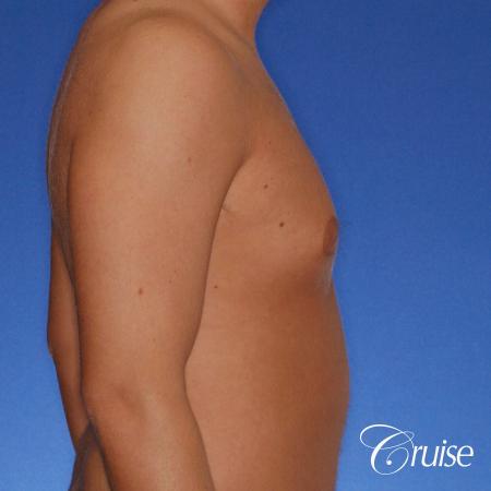 best puffy nipple gynecomastia results with plastic surgeon, Joseph Cruise, M.D. - Before and After Image 3
