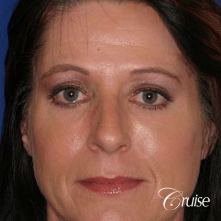 Amazing fat transfer results - After Image