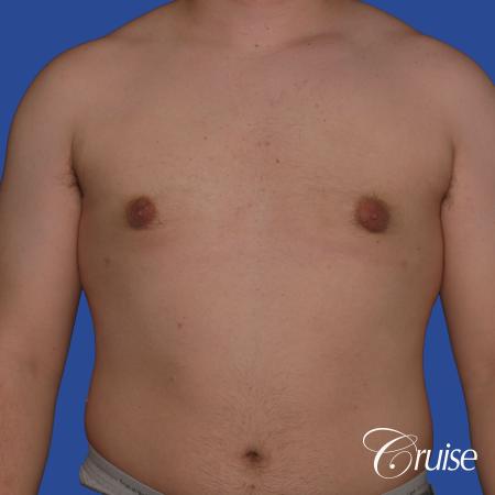 best scars for moderate gynecomastia - After Image 1