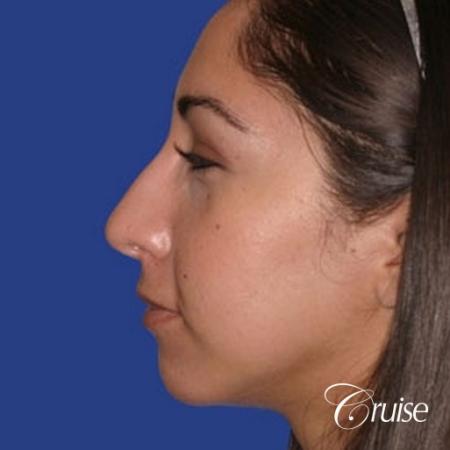anatomic chin implant with top plastic surgeon in Newport Beach - After Image 2
