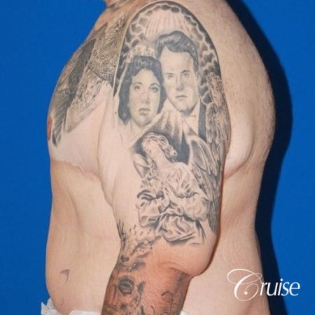 severe gynecomastia with free nipple graft on adult - After Image 2