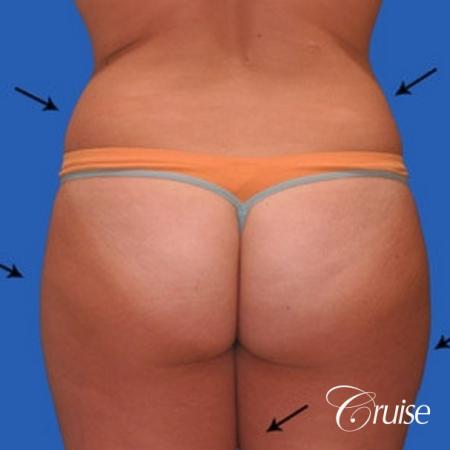 best liposuction results on abdomen, flanks, thighs - Before Image 2