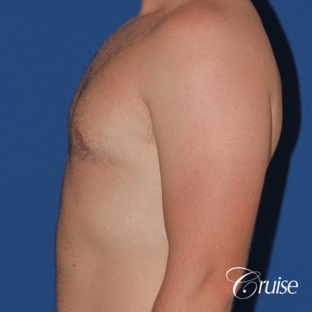 best puffy nipple surgery correction - After Image 2