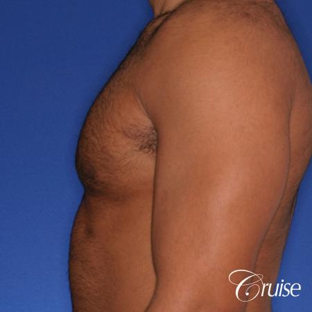 26 yo athletic patient with moderate gynecomastia - After Image 2