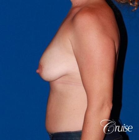 best results for breast lift anchor with saline implants - Before Image 2