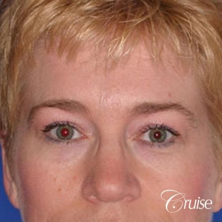 best specialist for upper eyelid surgery - Before Image 1