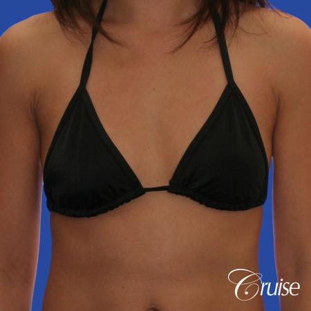 Breast Augmentation - Before 3