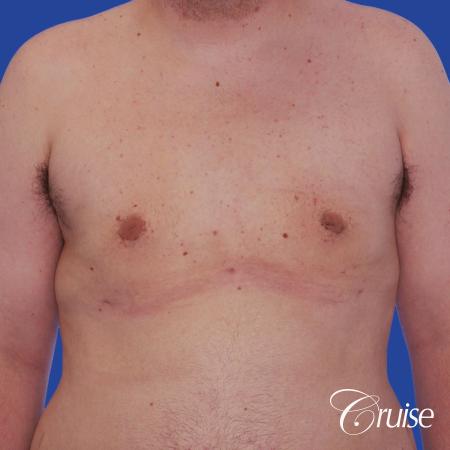 moderate gyne on young male adult - After Image 1