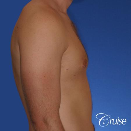 young adult with puffy nipple gets the best results with top gynecomastia surgeon - After Image 2