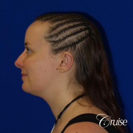 Otoplasty And Earlobe Repair: Patient 2 - After Image 3