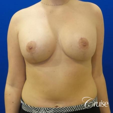 silicone implants with breast lift anchor newport beach - After Image 1