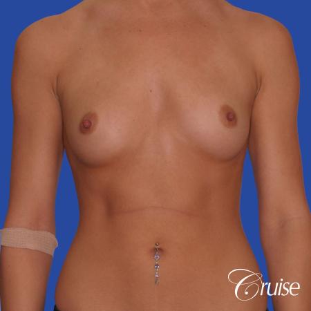 Breast Augmentation - Before Image 1