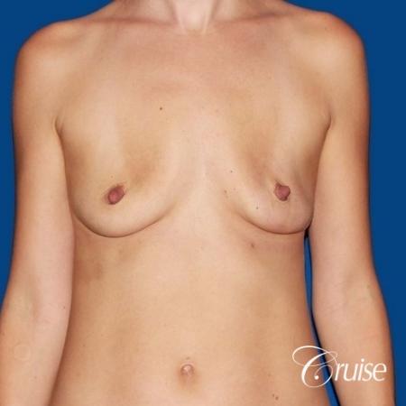 best breast lift anchor with High profile silicone 500cc implants - Before Image 1
