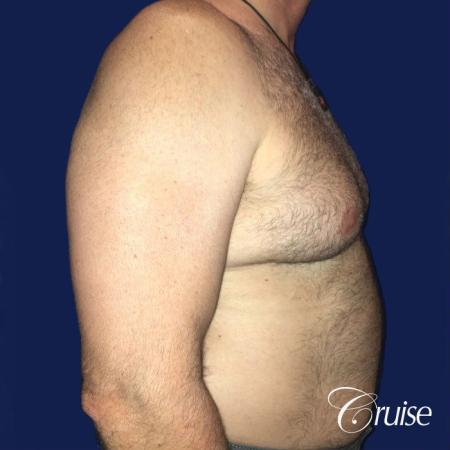 Severe Gynecomastia Correction - Before and After 3
