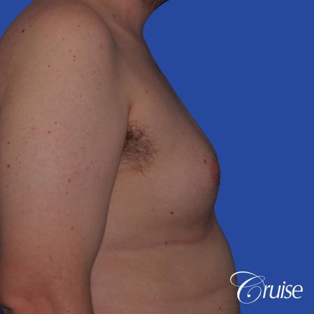 moderate gyne on young male adult - Before Image 3