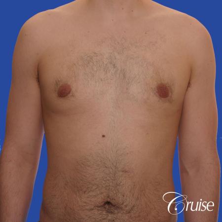 20 year old with moderate gynecomastia - After Image 1