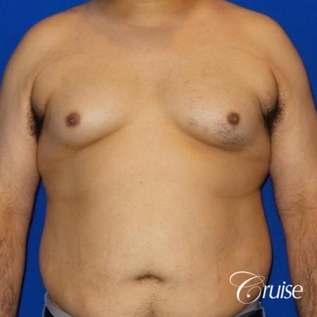 Gynecomastia -Free Nipple Graft - Before Image 1