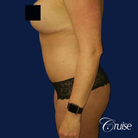 Best tummy tucks dr cruise - After Image 2