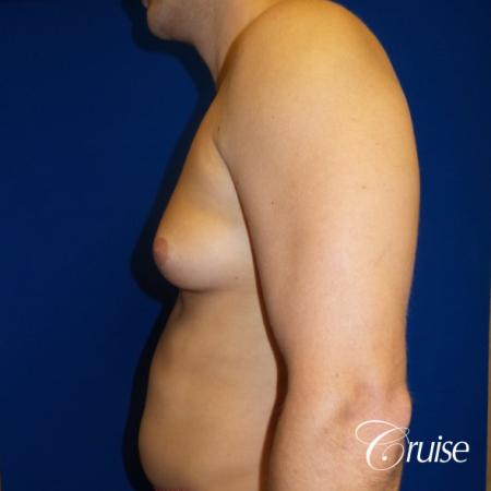 Unilateral gynecomastia - Before and After Image 3
