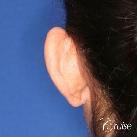 plastic surgeon does otoplasty in Newport beach - Before and After Image 3