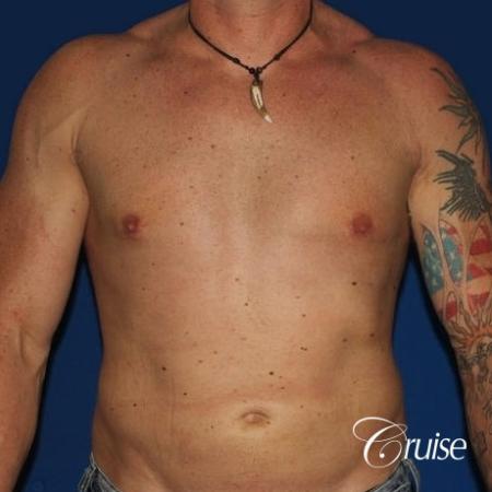 moderate gynecomastia with puffy nipple on athletic adult - After Image 1