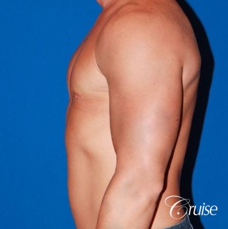 body builder with Gynecomastia puffy nipple - After Image 2