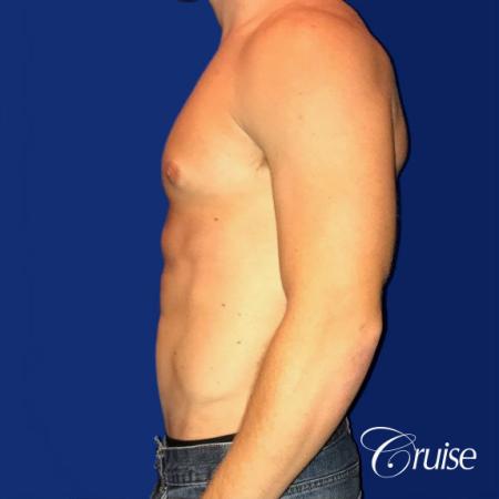 body builder puffy nipple gynecomastia - Before 2