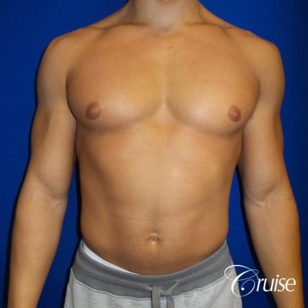 bodybuilder with gynecomastia - Before Image 1