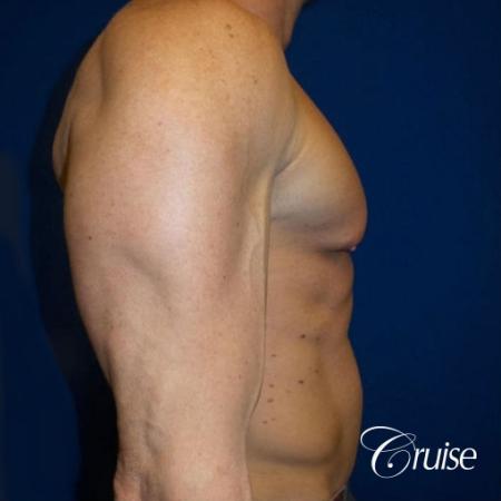 Body builder gynecomastia before and after pictures - Before and After 2