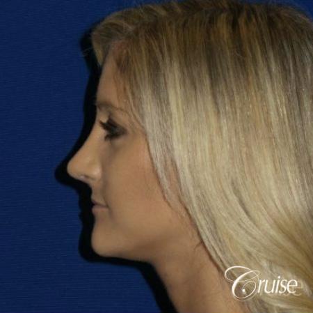 Best Rhinoplasty results Newport Beach CA - After Image 4