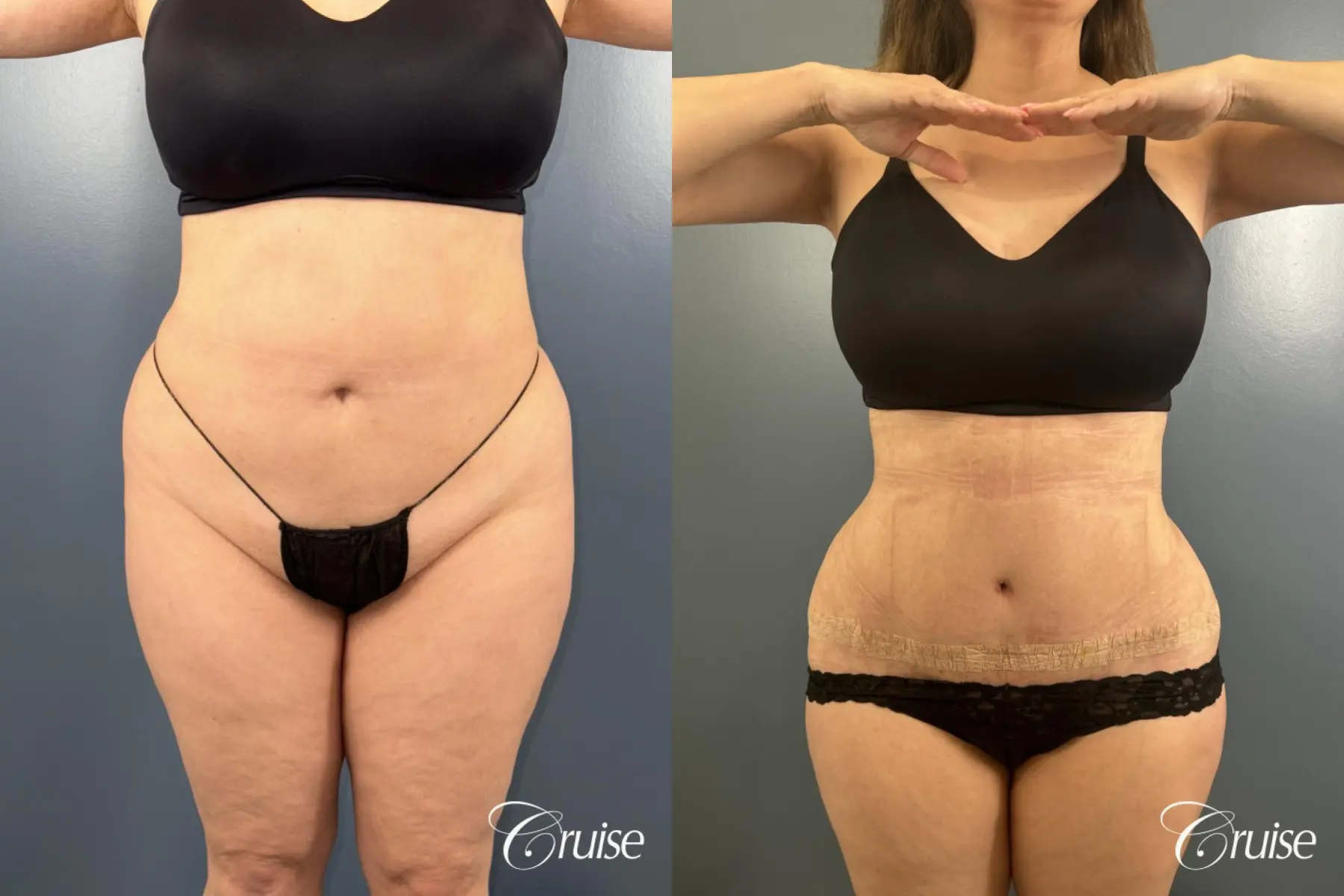 Abdominoplasty - Liposuction Back, Flanks- Fat Transfer, BBL - Before and After  