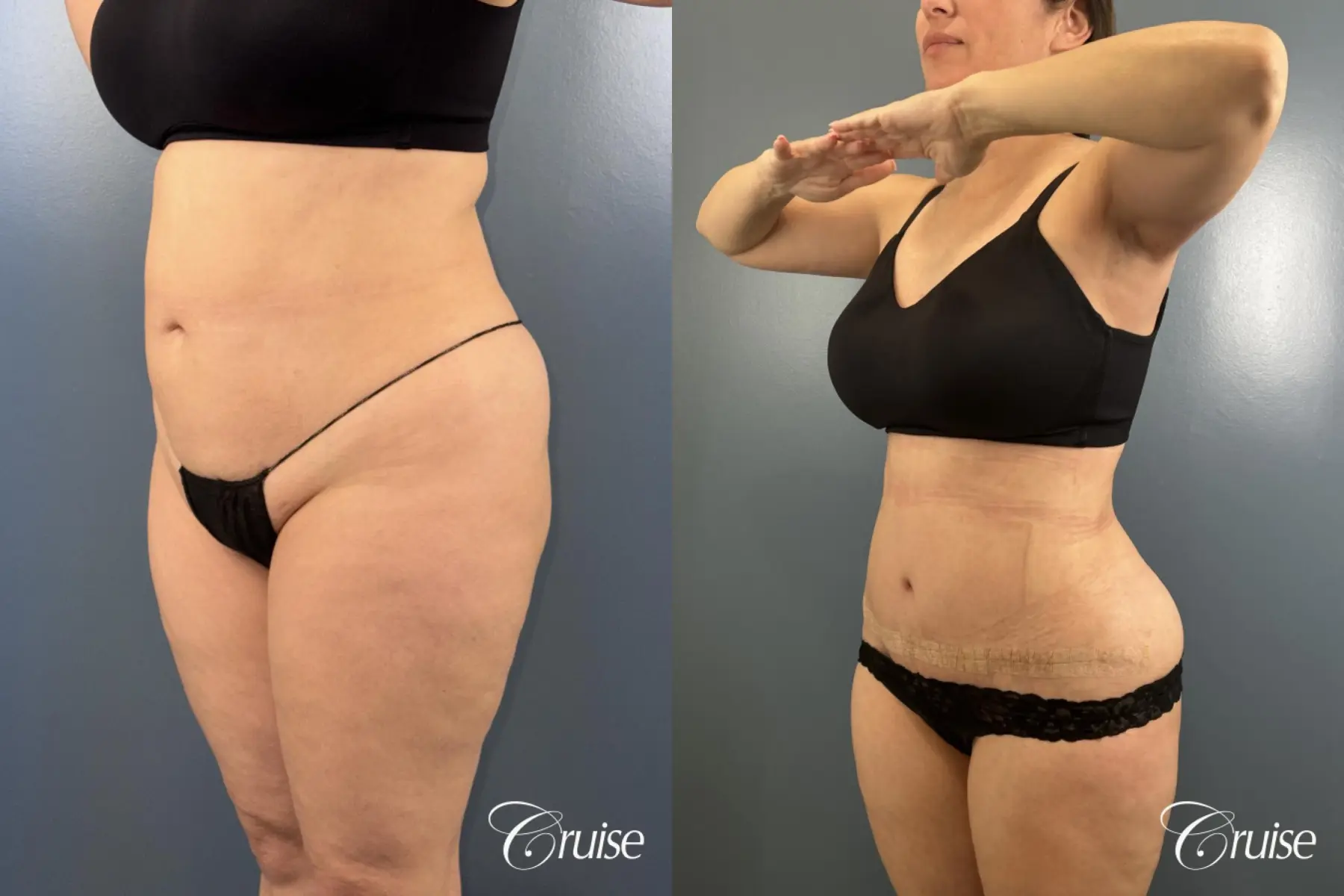 Abdominoplasty - Liposuction Back, Flanks- Fat Transfer, BBL - Before and After 2