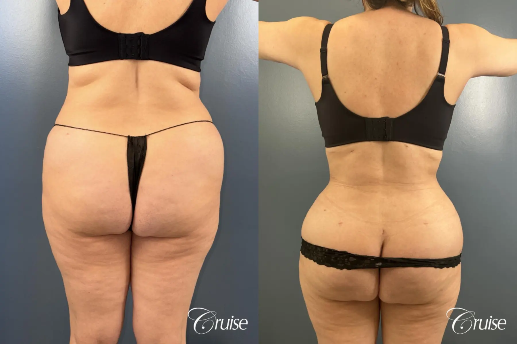 Abdominoplasty - Liposuction Back, Flanks- Fat Transfer, BBL - Before and After 3