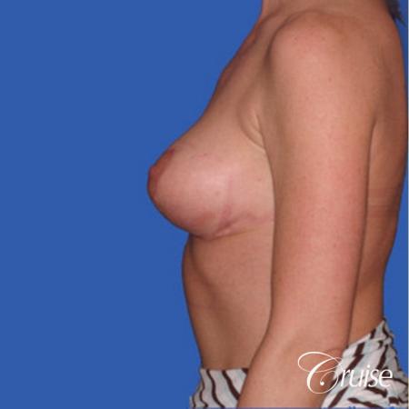 best breast reduction without implants - After Image 2