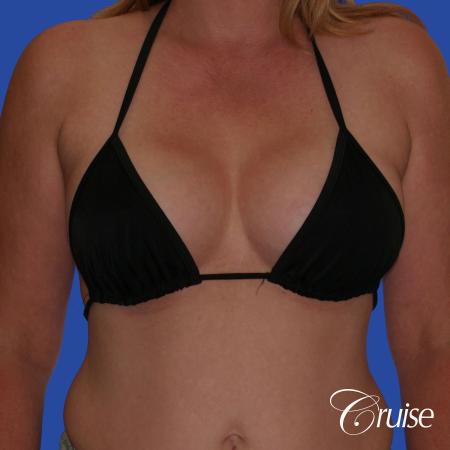 Breast Augmentation - After Image 3
