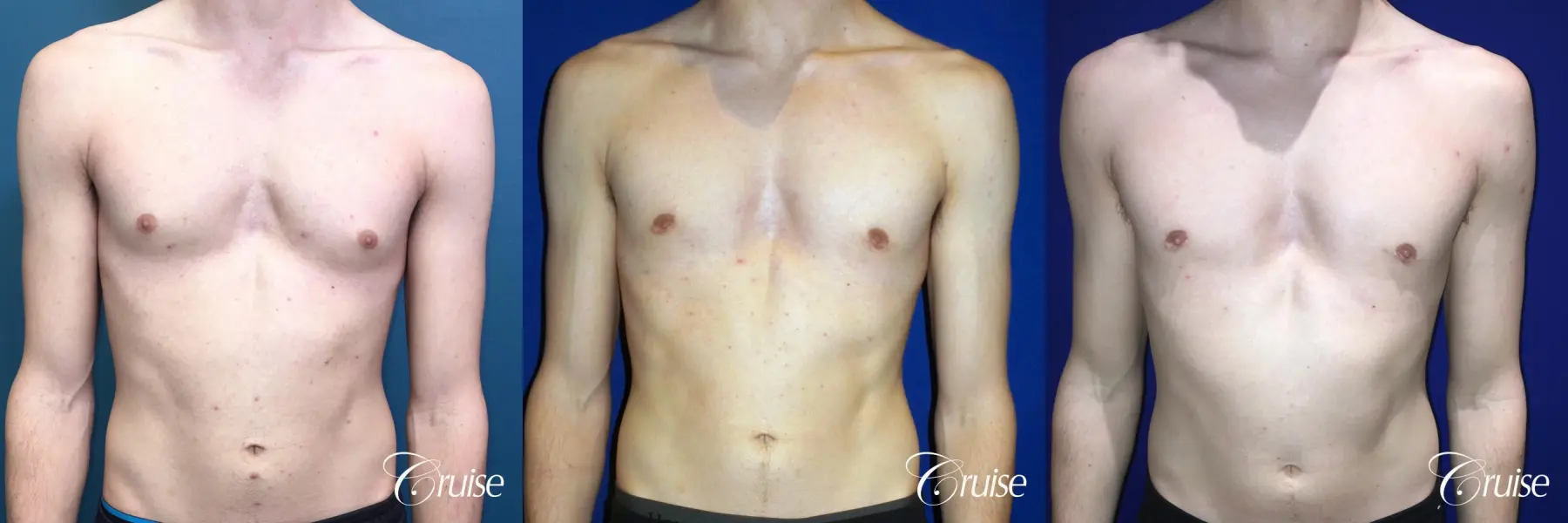 ALS - Body: Patient 1 - Before and After  