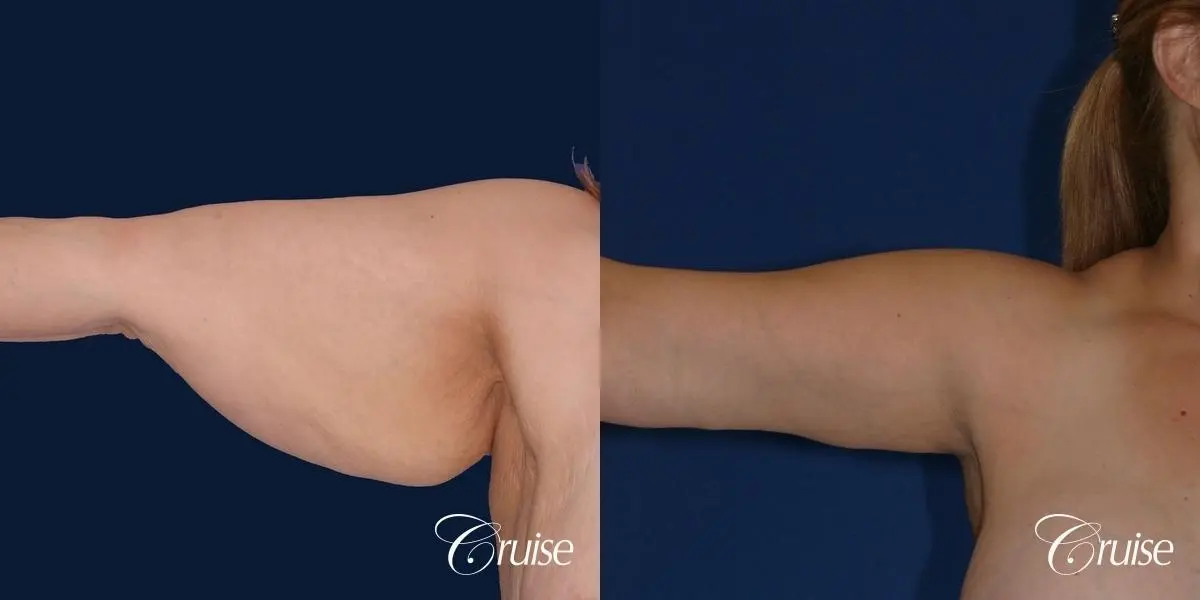 best arm lift newport beach - Before and After 2