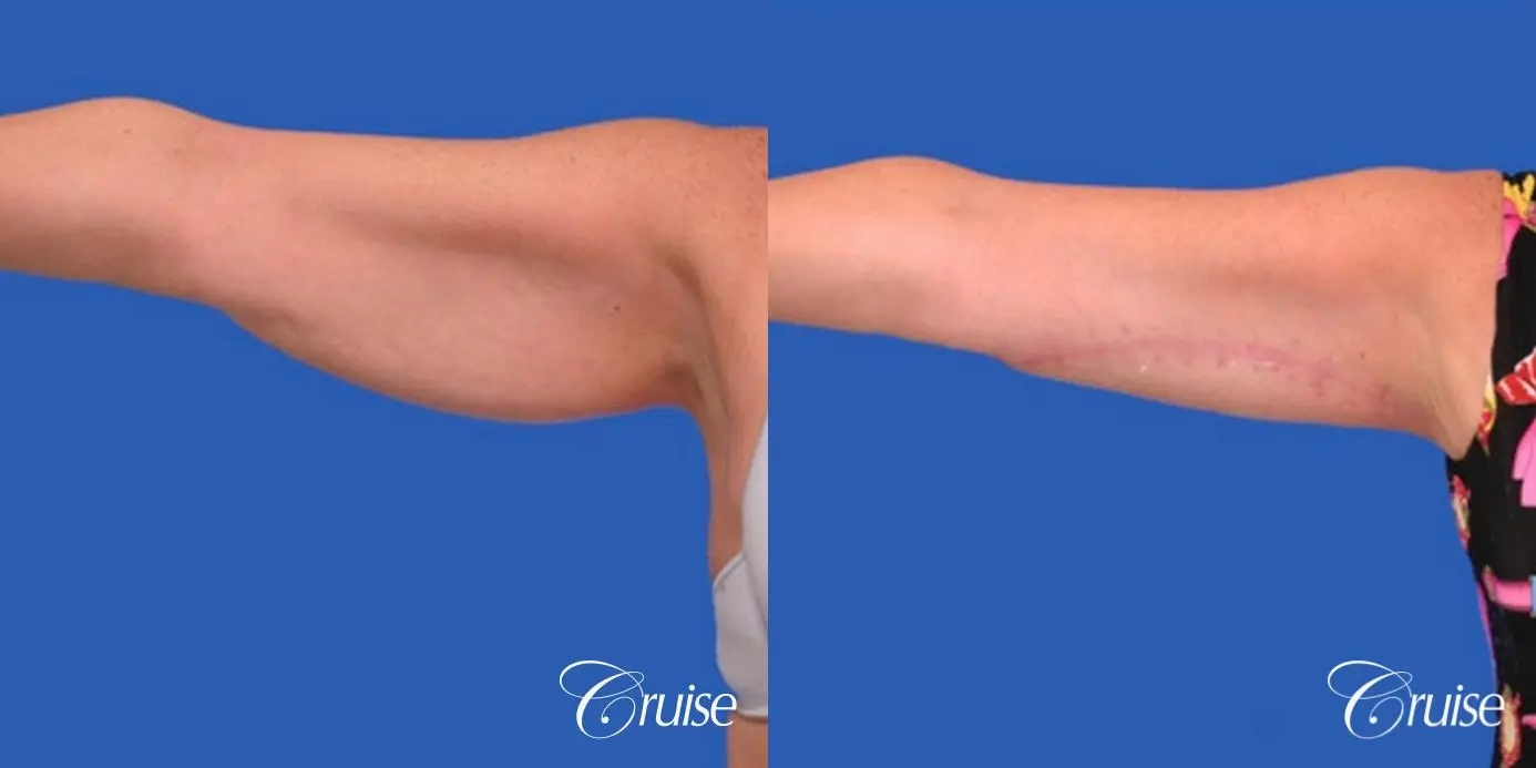 best arm lift newport beach - Before and After 2