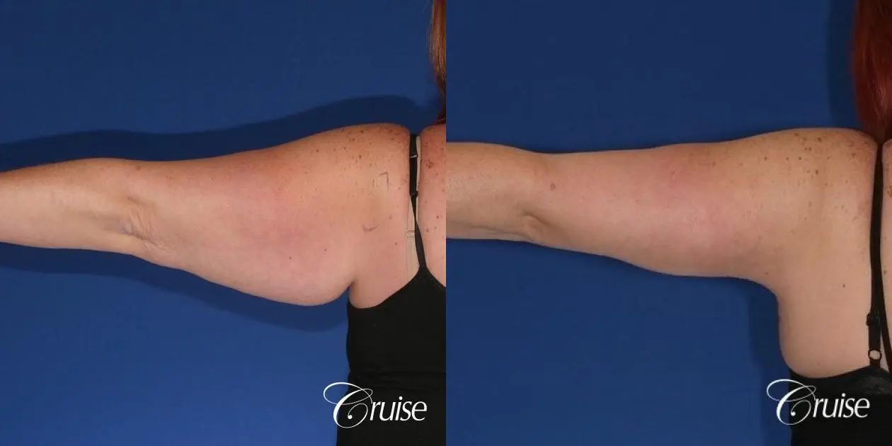 best recovery and photos of arm lift orange county - Before and After 1