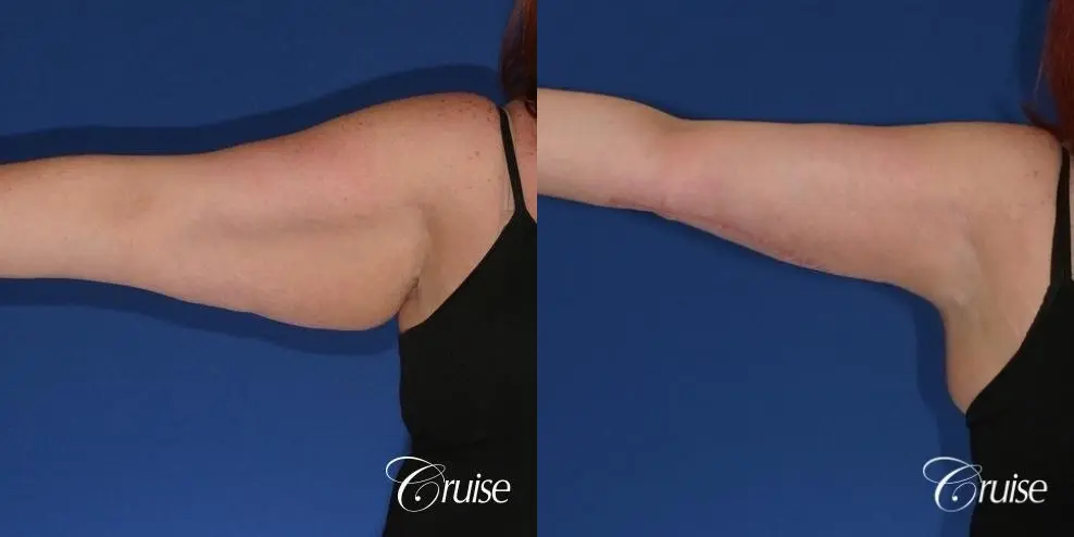 best recovery and photos of arm lift orange county - Before and After 3