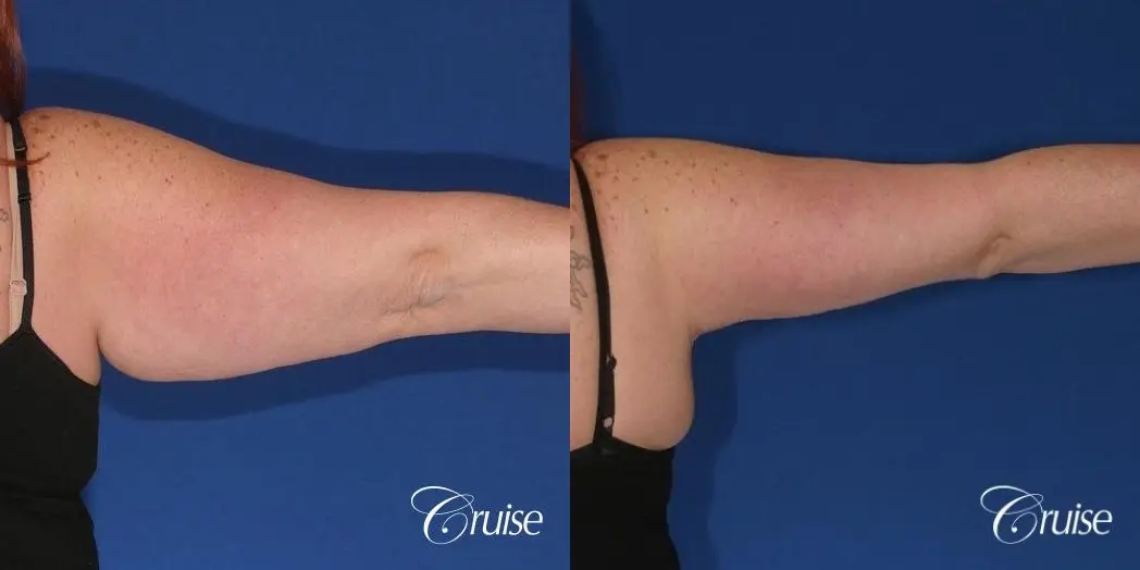 best recovery and photos of arm lift orange county - Before and After 2