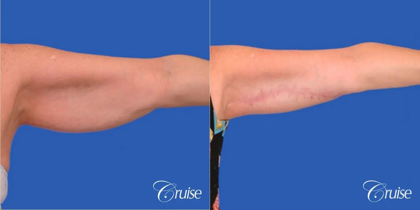 best arm lift newport beach - Before and After 1