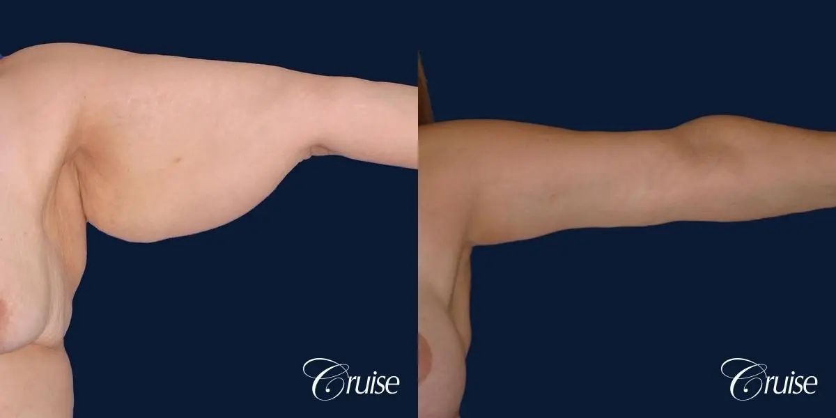 best arm lift newport beach - Before and After 3