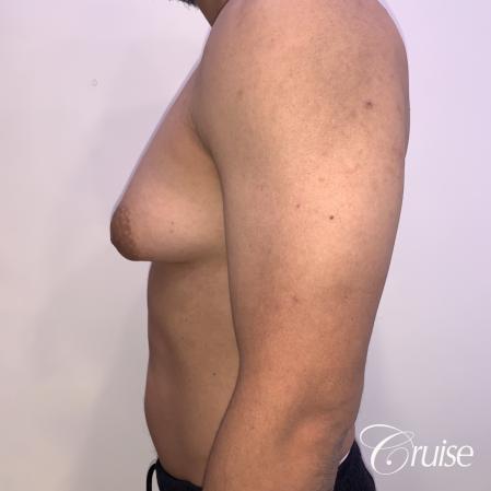 gynecomastia surgery - Before 2
