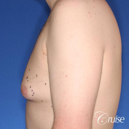 moderate gyne on 31 yr old male - Before Image 2