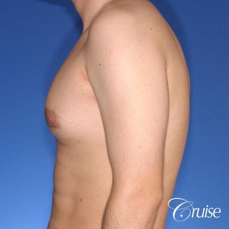 moderate gynecomastia puffy nipple - Before Image 2