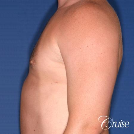 male adult with gynecomastia - After Image 2