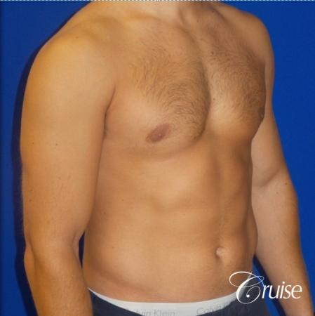 male breast reduction surgery newport beach - After Image 2
