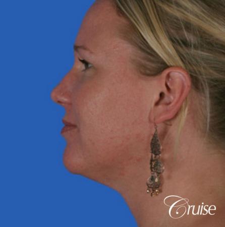 best liposuction neck and jawline for double chin - After Image 2