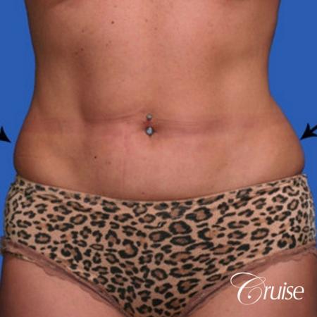 best lipo photos of love handles and stomach - Before Image 1